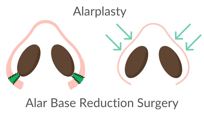 Alar Base Reduction Surgery