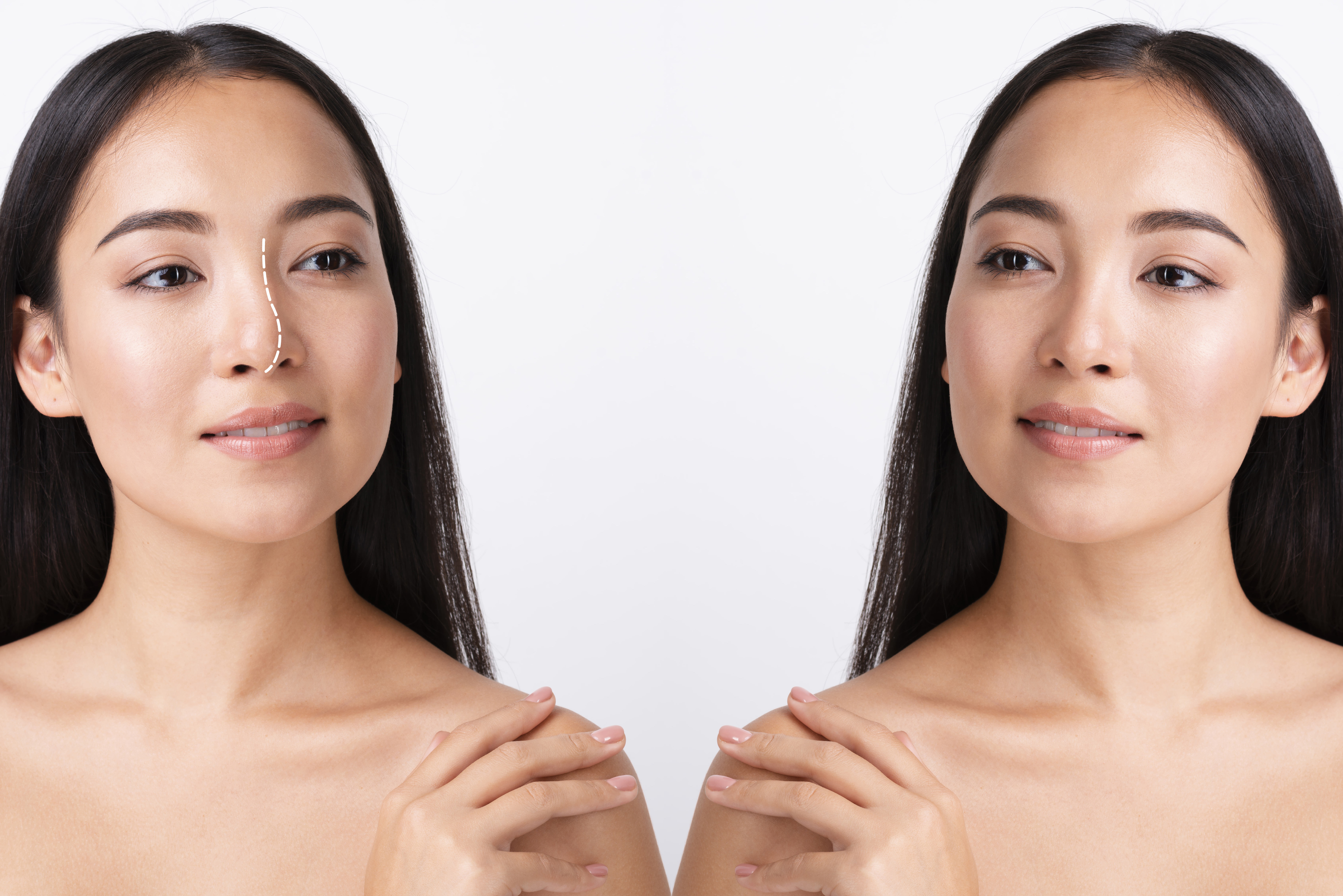 What is Asian Rhinoplasty