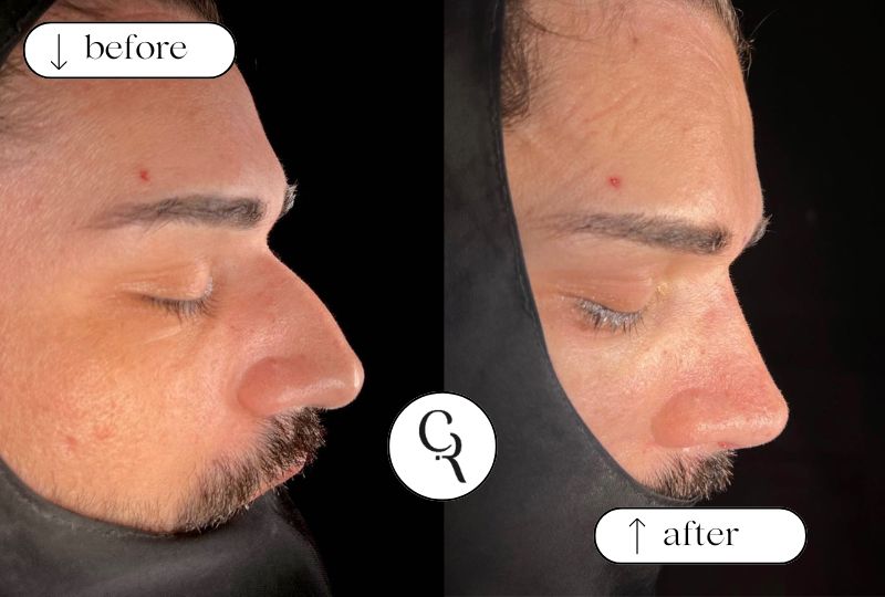 Before and after male rhinoplasty Turkey