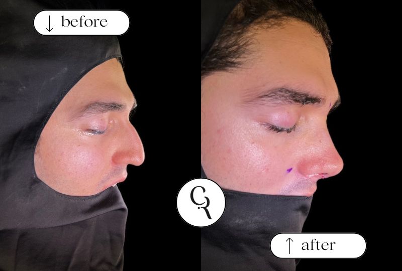 Before and after male rhinoplasty Istanbul