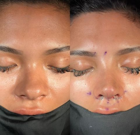 Ethnic rhinoplasty Istanbul before and after – nose type result front view