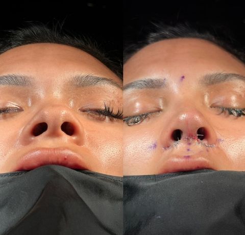Ethnic rhinoplasty Istanbul before and after – nose type result basal (from below) view