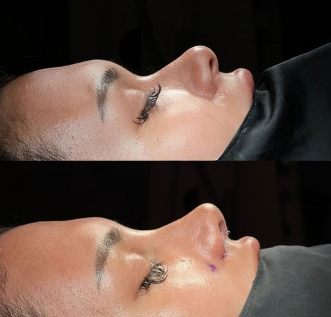 Ethnic rhinoplasty Turkey before and after – nose type result lateral (side) view