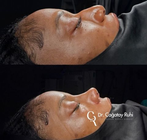 Ethnic rhinoplasty Turkey before and after – Afro-Caribbean nose type result lateral (side) view