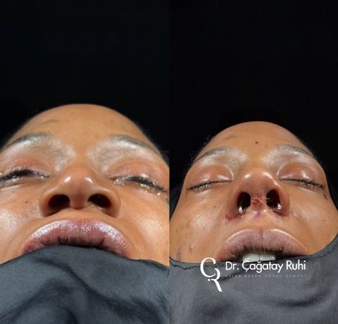 Ethnic rhinoplasty Turkey before and after – Afro-Caribbean nose type result basal (from below) view