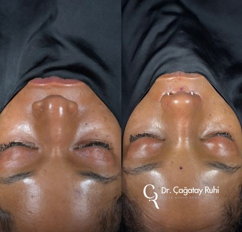 Ethnic rhinoplasty Turkey before and after – Afro-Caribbean nose type result top (from above) view