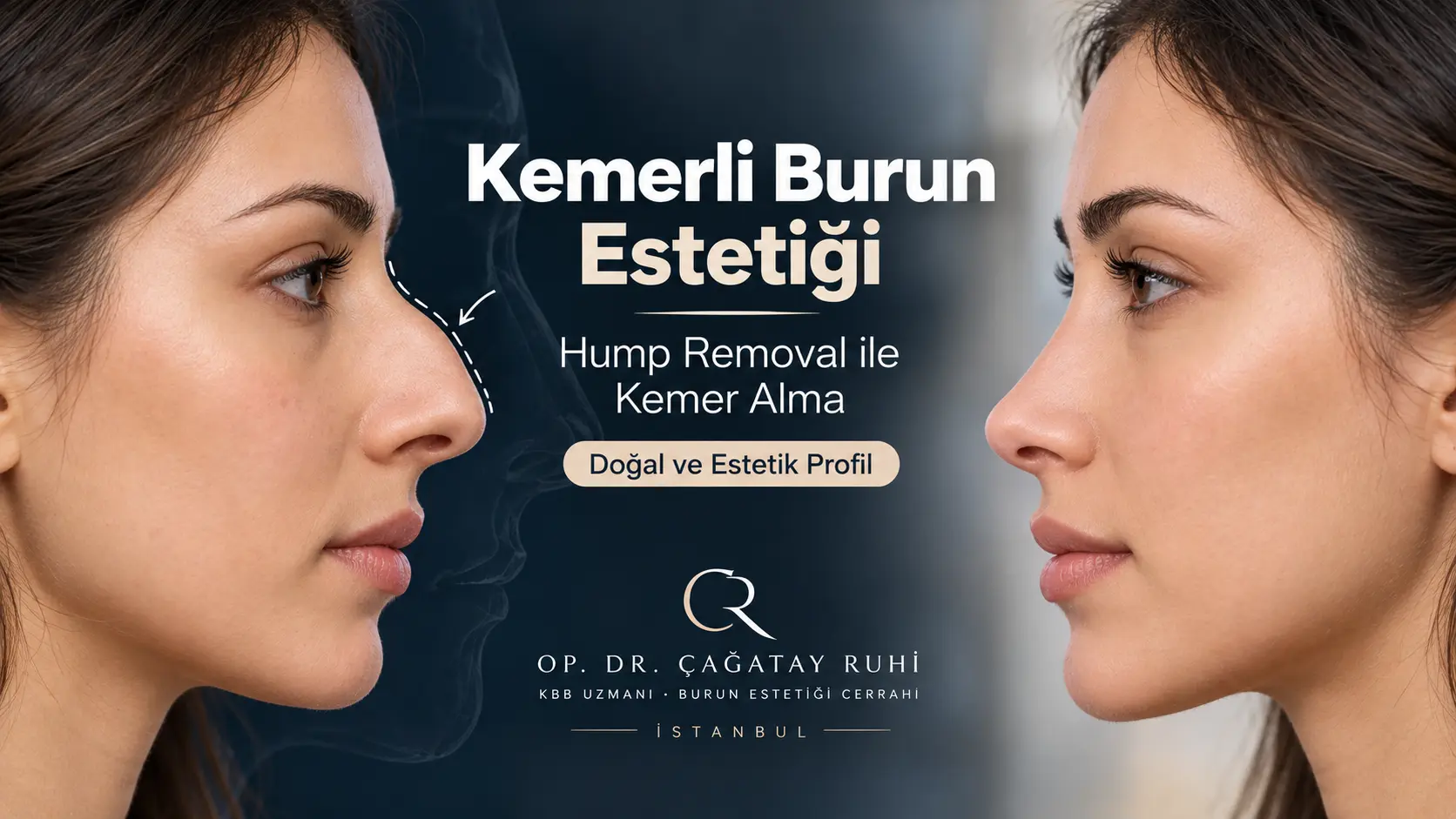 Kemerli Burun Estetiği Hump Removal - Op. Dr. Çağatay Ruhi İstanbul