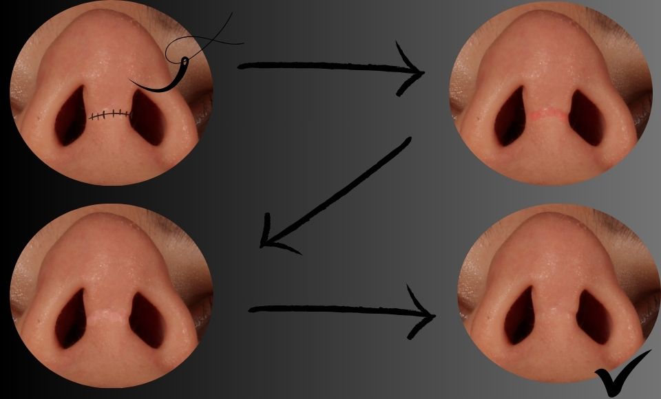 Burun Estetiği Sonrası Dikiş İzi Ne zaman Geçer?İstanbul