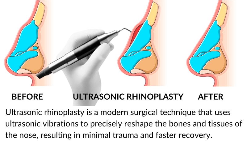 What is ultrasonic rhinoplasty?