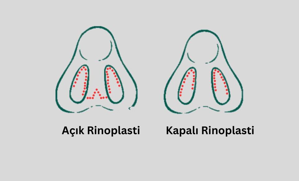 İstanbul'da Açık Kapılı Burun Estetiği